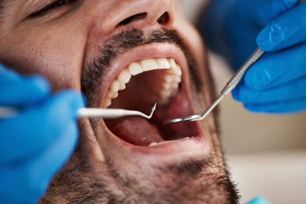 Best Emergency Dental Care for Broken or Chipped Teeth in Dover, NJ
