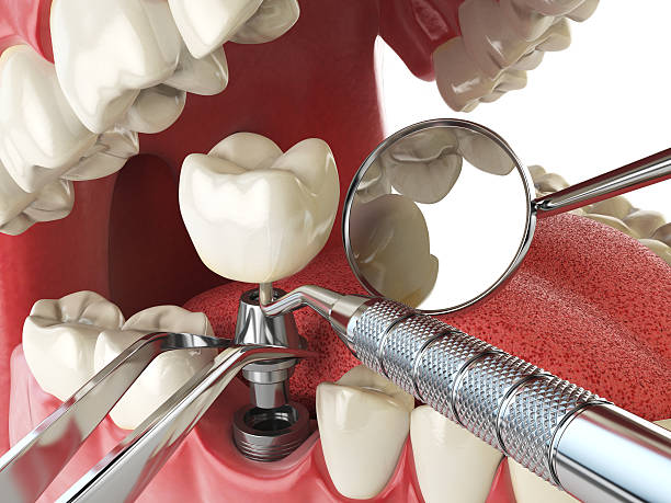 Best Emergency Root Canal Treatment in Dover, NJ